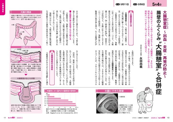 大腸憩室症 〜出血・炎症・再発の防止〜